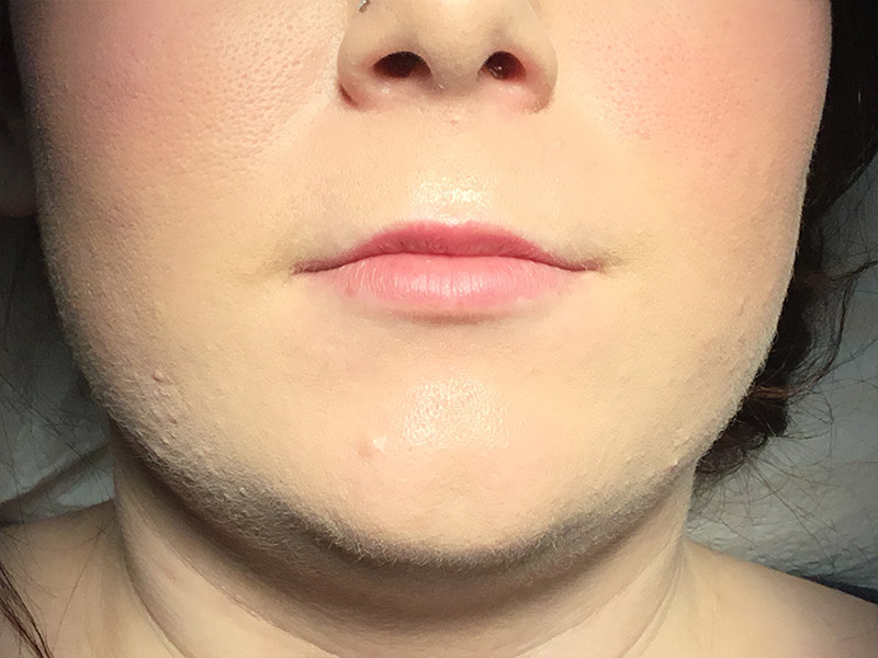 Lip Fillers Before and After | Montilla Plastic Surgery 