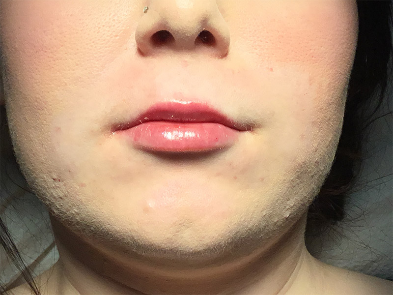 Lip Fillers Before and After | Montilla Plastic Surgery 