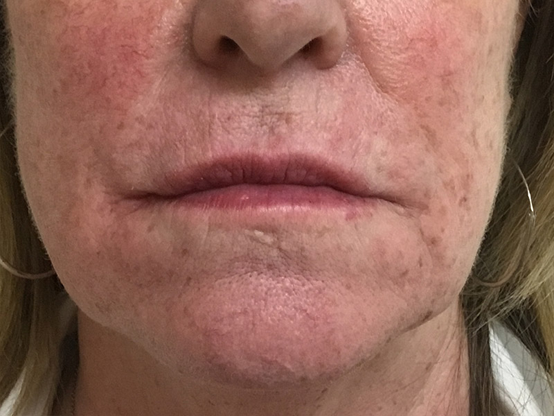 Lip Fillers Before and After | Montilla Plastic Surgery 