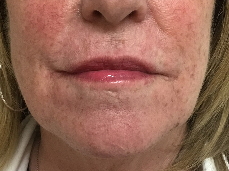 Lip Fillers Before and After | Montilla Plastic Surgery 