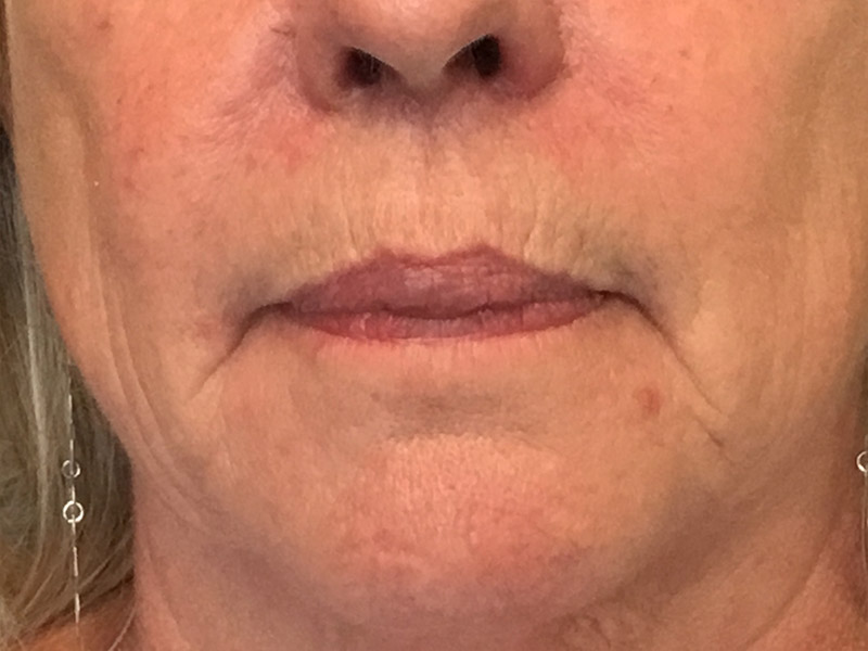 Lip Fillers Before and After | Montilla Plastic Surgery 