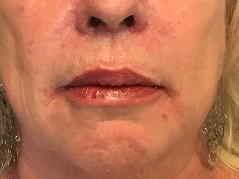 Lip Fillers Before and After | Montilla Plastic Surgery 