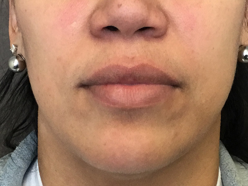 Lip Fillers Before and After | Montilla Plastic Surgery 