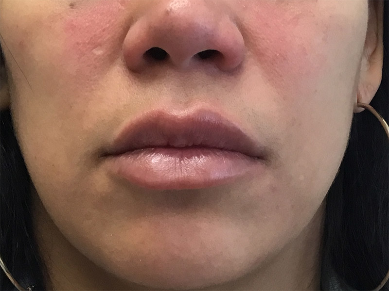 Lip Fillers Before and After | Montilla Plastic Surgery 