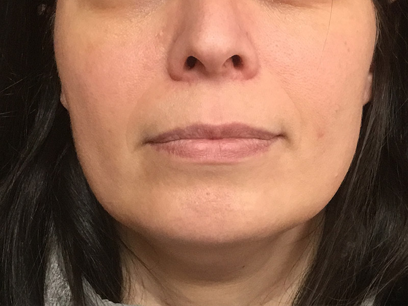 Lip Fillers Before and After | Montilla Plastic Surgery 