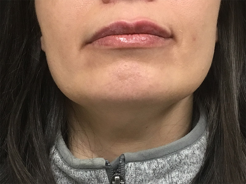 Lip Fillers Before and After | Montilla Plastic Surgery 