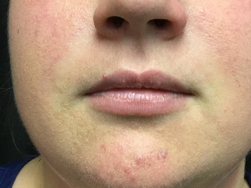 Lip Fillers Before and After | Montilla Plastic Surgery 