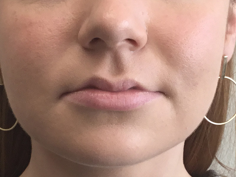 Lip Fillers Before and After | Montilla Plastic Surgery 