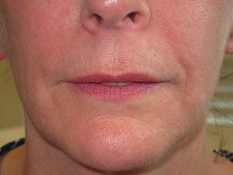 Lip Fillers Before and After | Montilla Plastic Surgery 