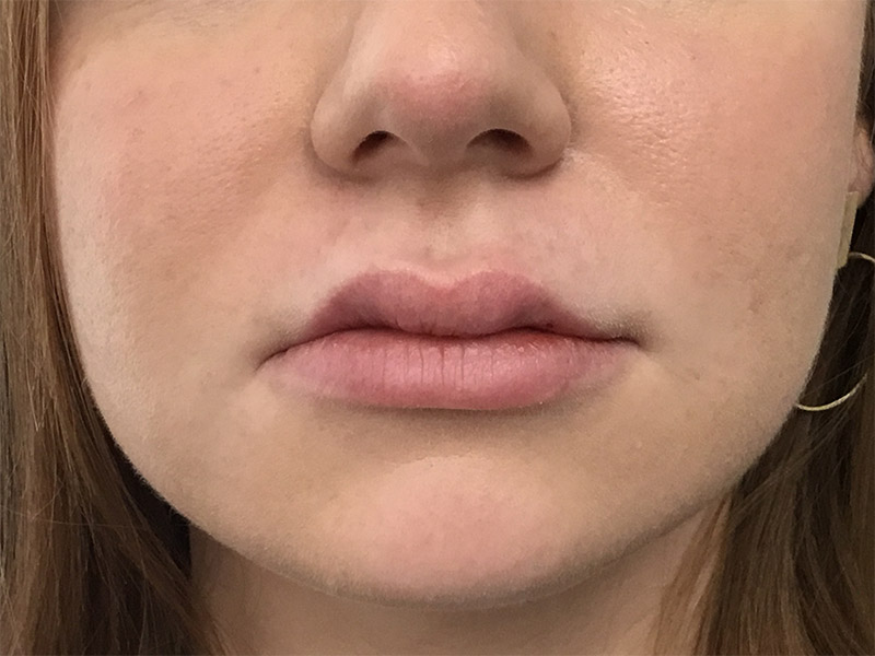 Lip Fillers Before and After | Montilla Plastic Surgery 