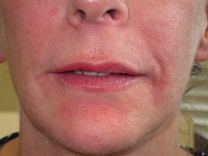 Lip Fillers Before and After | Montilla Plastic Surgery 