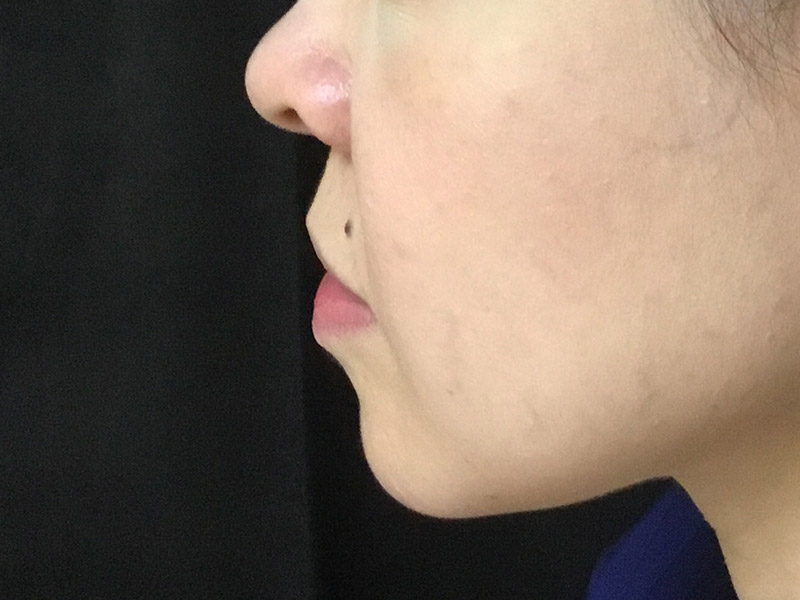 Lip Fillers Before and After | Montilla Plastic Surgery 