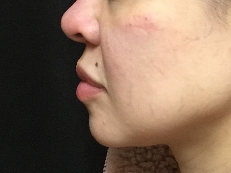 Lip Fillers Before and After | Montilla Plastic Surgery 