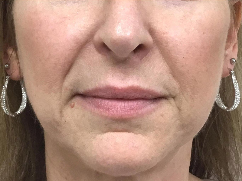 Lip Fillers Before and After | Montilla Plastic Surgery 
