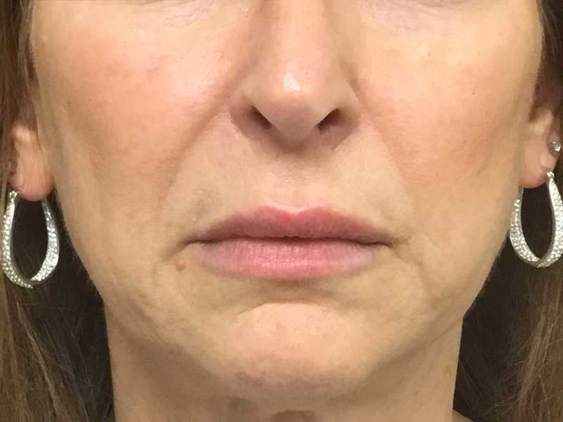 Lip Fillers Before and After | Montilla Plastic Surgery 