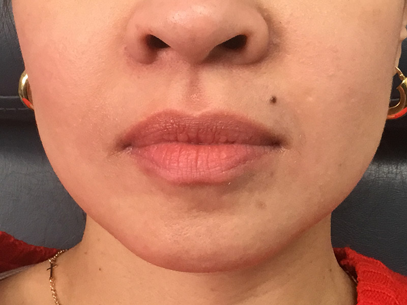 Lip Fillers Before and After | Montilla Plastic Surgery 