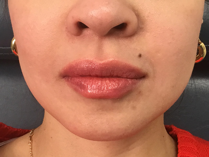Lip Fillers Before and After | Montilla Plastic Surgery 