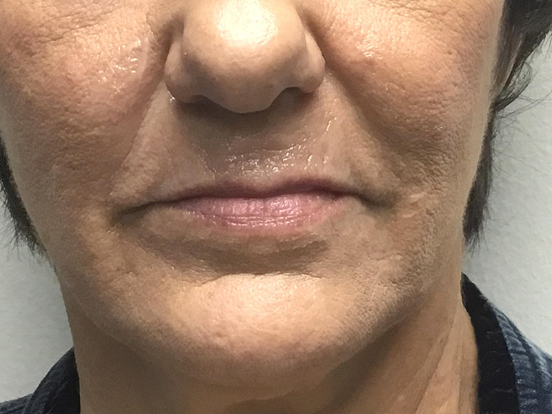 Lip Fillers Before and After | Montilla Plastic Surgery 