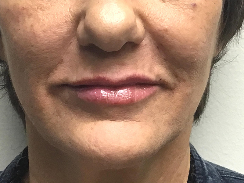 Lip Fillers Before and After | Montilla Plastic Surgery 