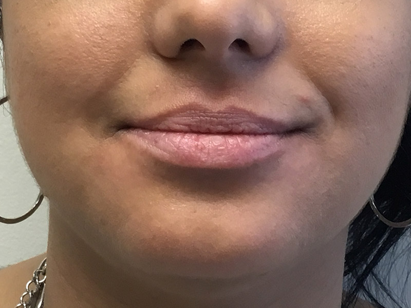 Lip Fillers Before and After | Montilla Plastic Surgery 