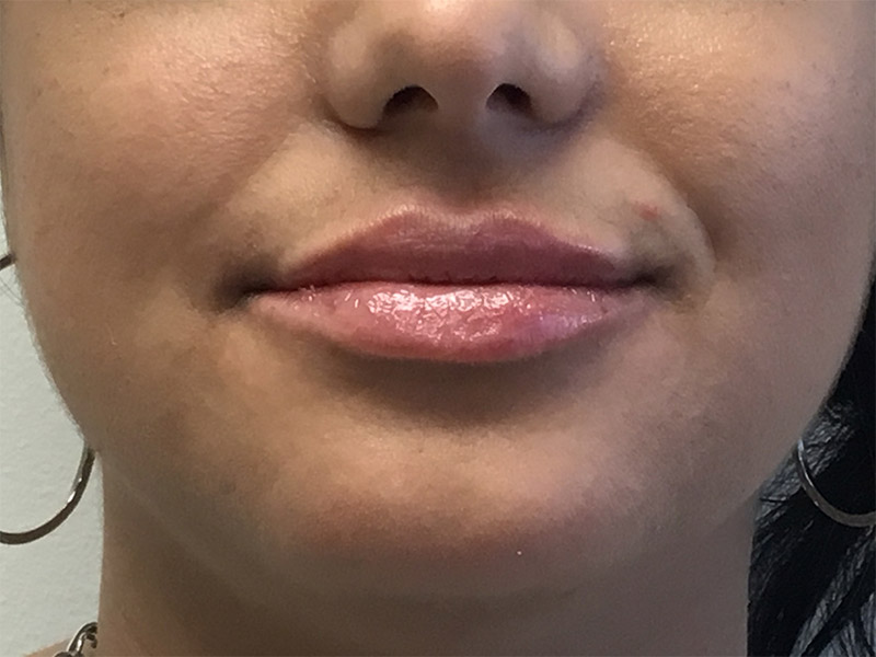 Lip Fillers Before and After | Montilla Plastic Surgery