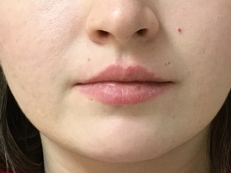 Lip Fillers Before and After | Montilla Plastic Surgery 