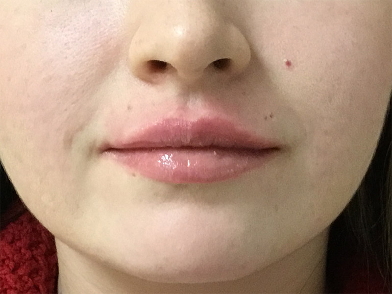 Lip Fillers Before and After | Montilla Plastic Surgery