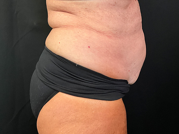 Liposuction Before and After | Montilla Plastic Surgery