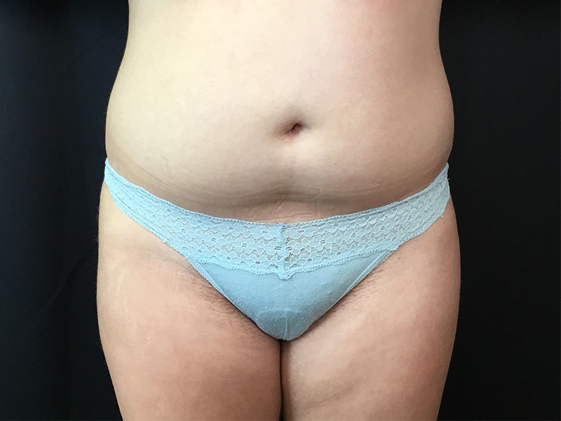 Liposuction Before and After | Montilla Plastic Surgery 