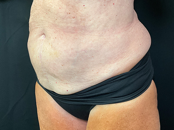 Liposuction Before and After | Montilla Plastic Surgery