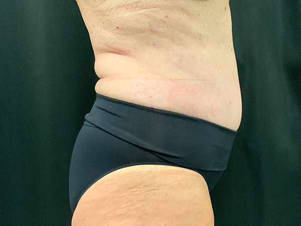 Liposuction Before and After | Montilla Plastic Surgery