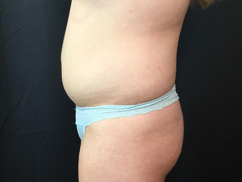 Liposuction Before and After | Montilla Plastic Surgery