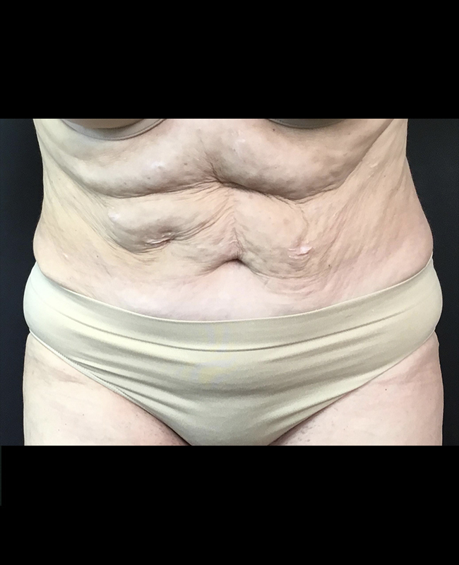 Liposuction Before and After | Montilla Plastic Surgery 