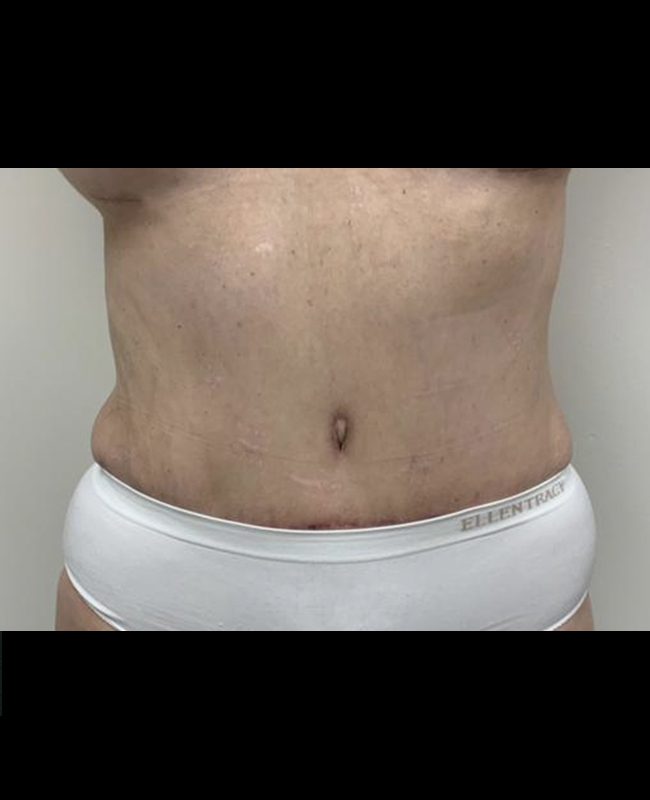 Liposuction Before and After | Montilla Plastic Surgery 