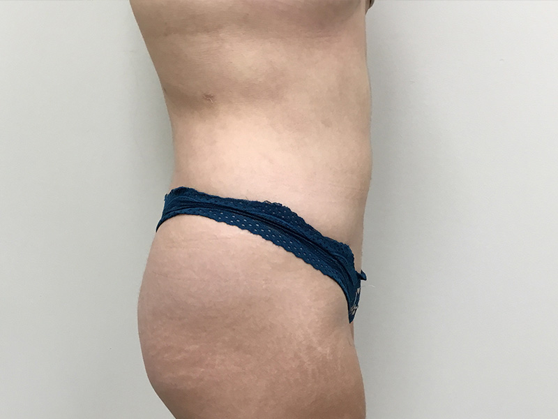 Liposuction Before and After | Montilla Plastic Surgery