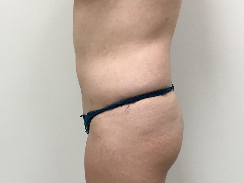 Liposuction Before and After | Montilla Plastic Surgery