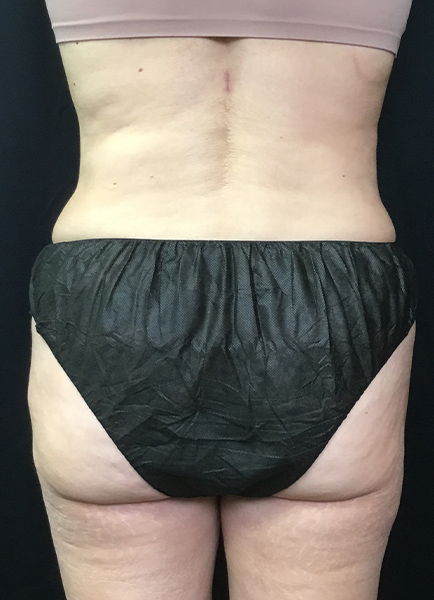 Liposuction Before and After | Montilla Plastic Surgery