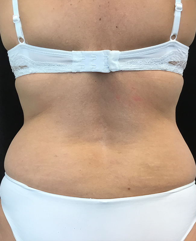 Liposuction Before and After | Montilla Plastic Surgery 