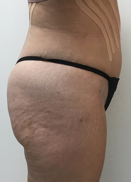 Liposuction Before and After | Montilla Plastic Surgery