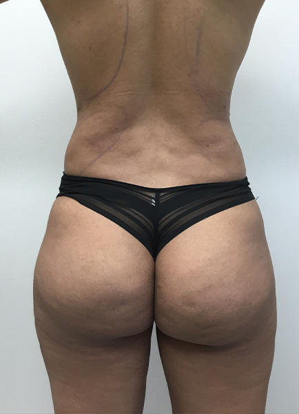 Liposuction Before and After | Montilla Plastic Surgery