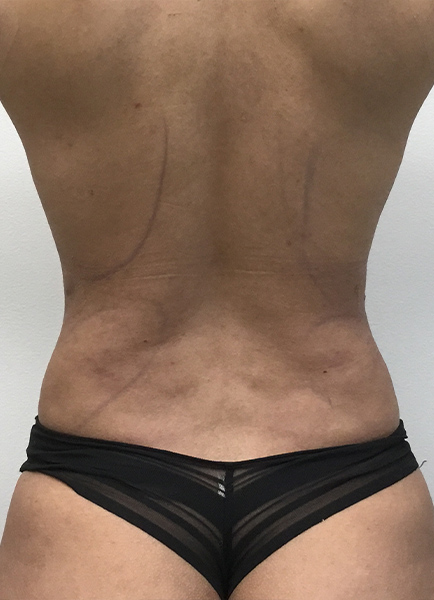 Liposuction Before and After | Montilla Plastic Surgery