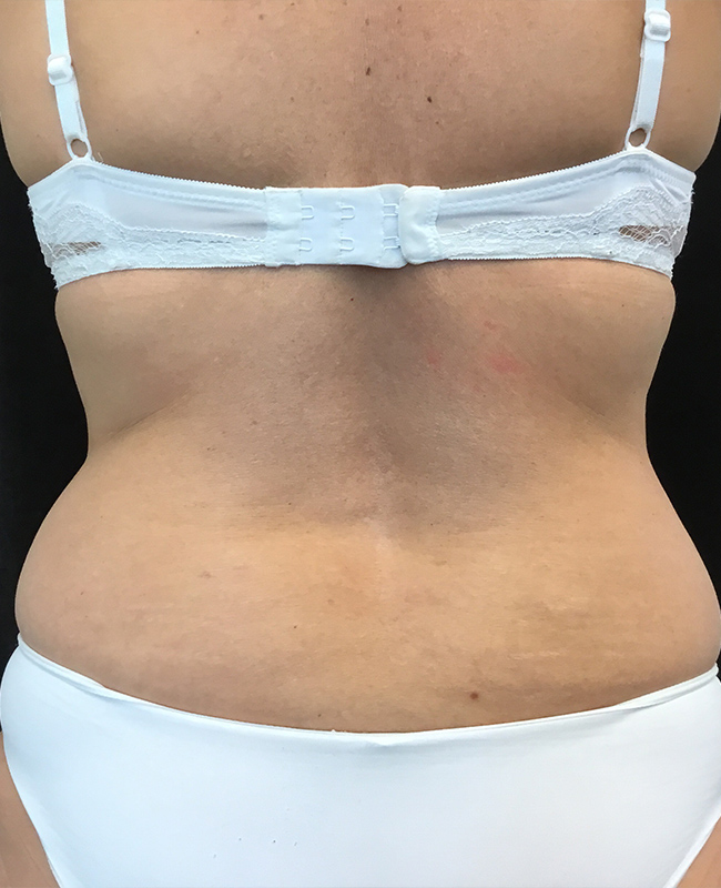 Liposuction Before and After | Montilla Plastic Surgery
