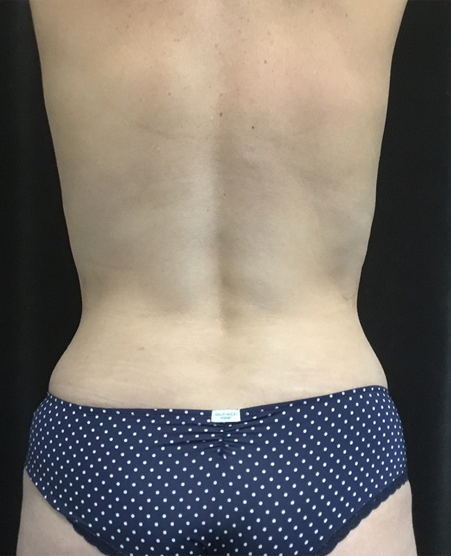 Liposuction Before and After | Montilla Plastic Surgery