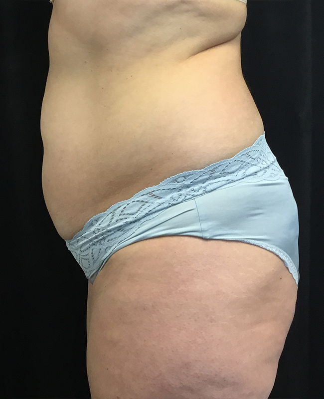 Liposuction Before and After | Montilla Plastic Surgery