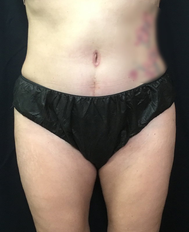 Liposuction Before and After | Montilla Plastic Surgery