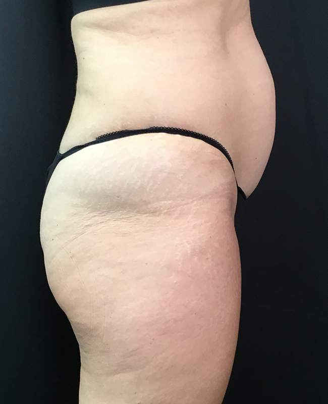 Liposuction Before and After | Montilla Plastic Surgery