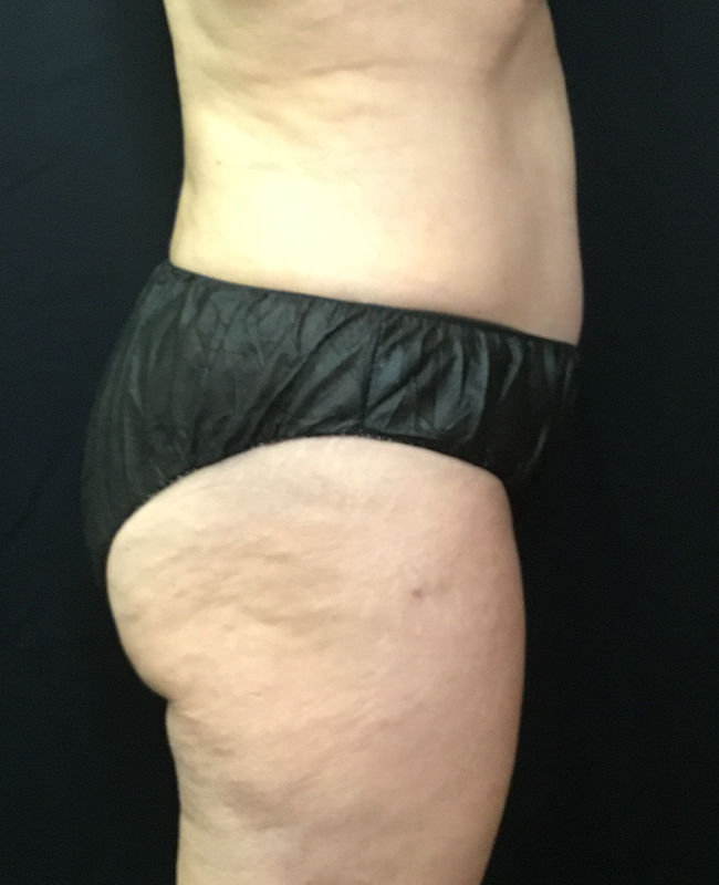 Liposuction Before and After | Montilla Plastic Surgery