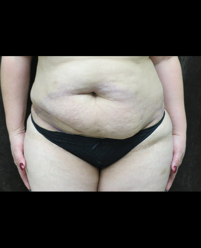 Liposuction Before and After | Montilla Plastic Surgery