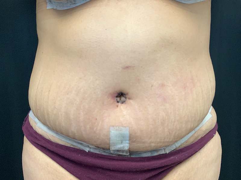 Lymphatic Drainage Massage Before and After | Montilla Plastic Surgery