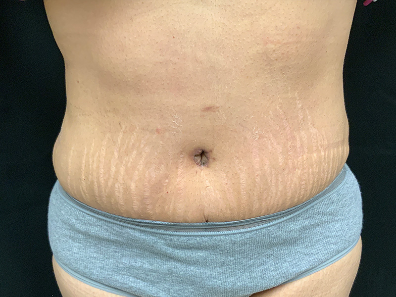 Lymphatic Drainage Massage Before and After | Montilla Plastic Surgery